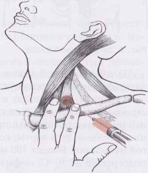БЛОКАДА ПЕРЕДНЕЙ ЛЕСТНИЧНОЙ МЫШЦЫ БЛОКАДА ПЕРЕДНЕЙ ЛЕСТНИЧНОЙ МЫШЦЫ